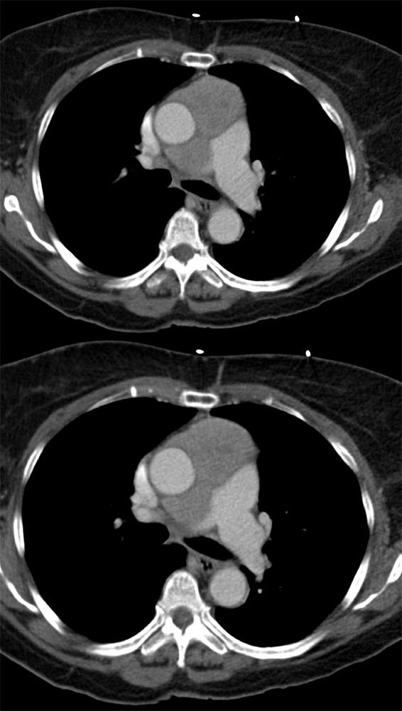 Plasmablastic Lymphoma on Pelvic Bx