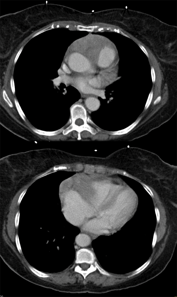 Plasmablastic Lymphoma on Pelvic Bx