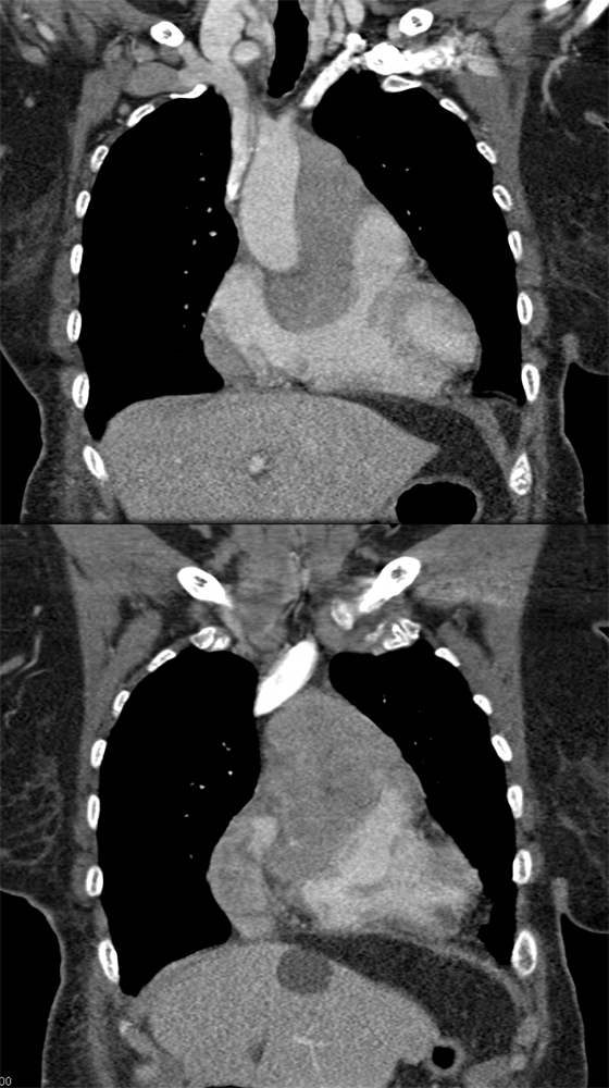 Plasmablastic Lymphoma on Pelvic Bx