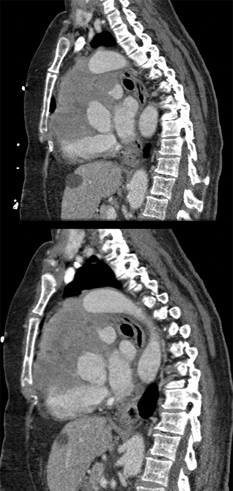 Plasmablastic Lymphoma on Pelvic Bx