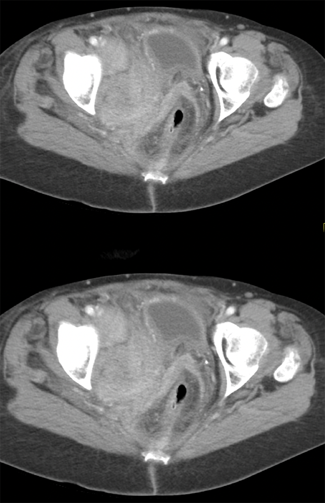 Plasmablastic Lymphoma on Pelvic Bx