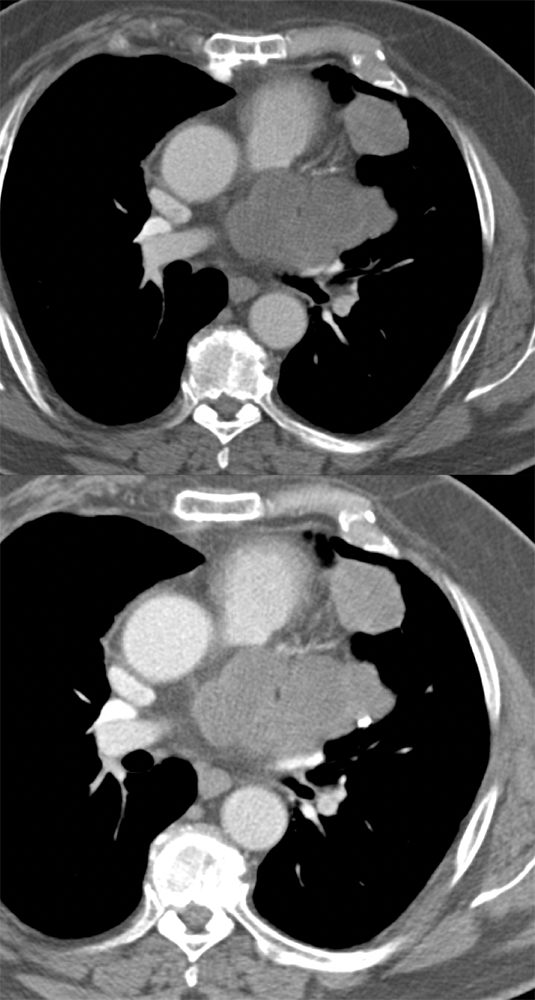 Spindle Cell Sarcoma of Left Atrial Appendage