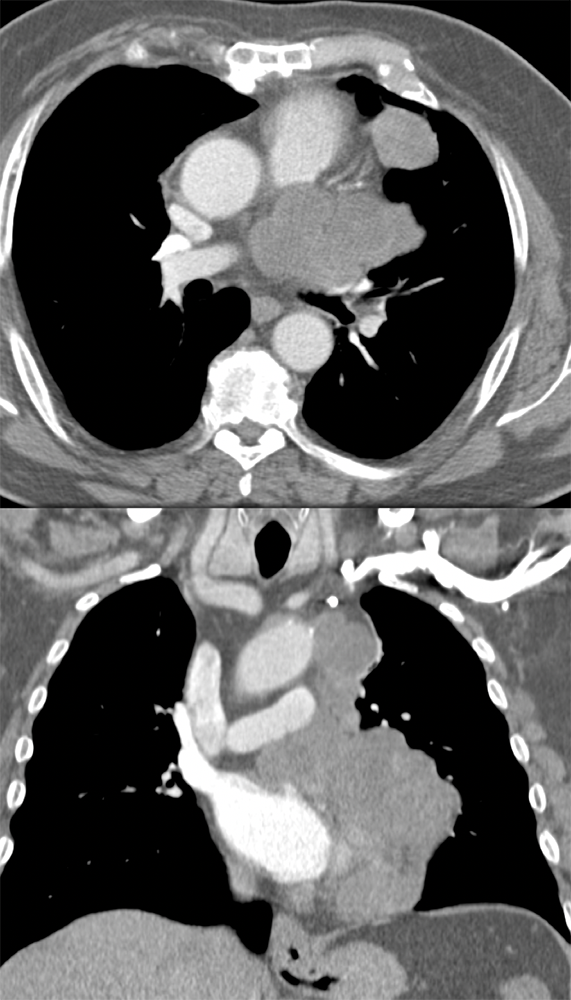 Spindle Cell Sarcoma of Left Atrial Appendage