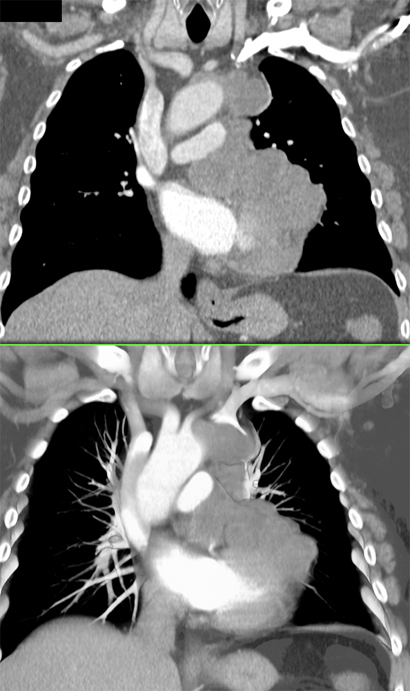 Spindle Cell Sarcoma of Left Atrial Appendage