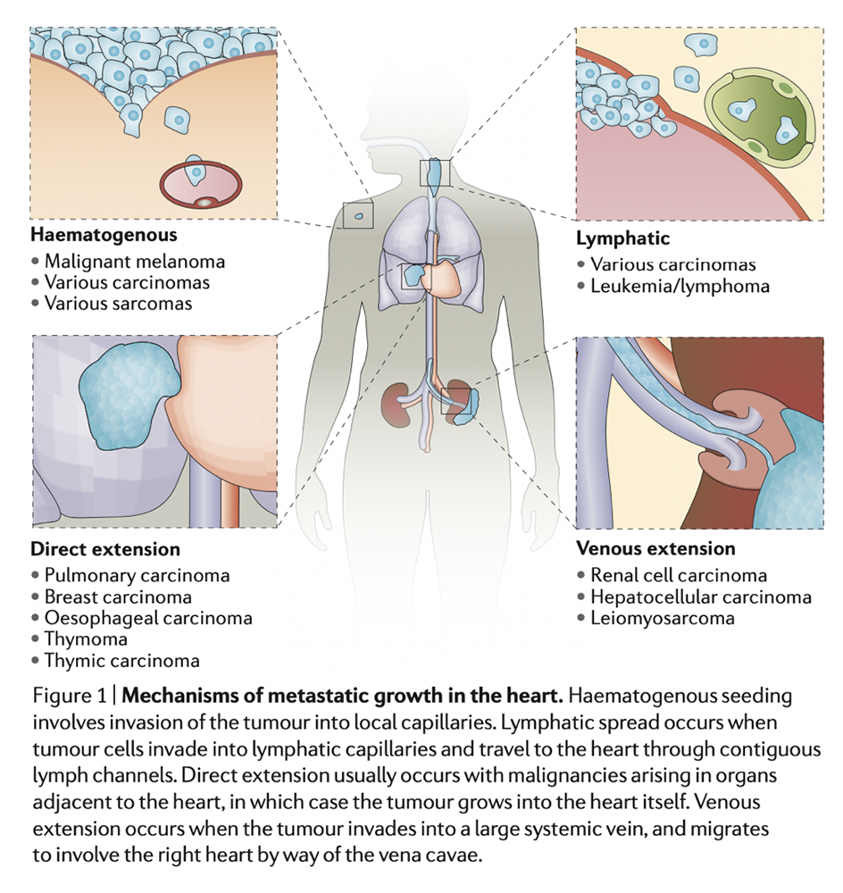 Cardiac Masses