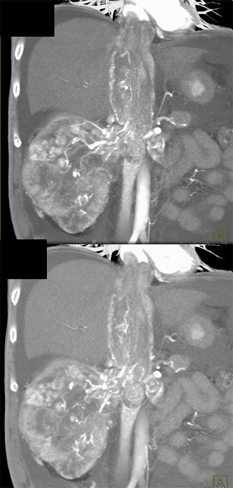 Renal Cell Carcinoma Invades the Renal Veins and IVC