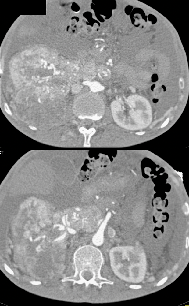 Renal Cell Carcinoma Invades the Renal Veins and IVC