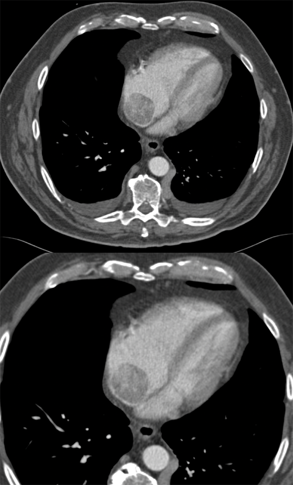 RCC Invades Renal Vein, IVC and Right Atrium