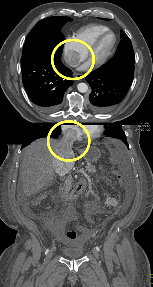 RCC Invades Renal Vein, IVC and Right Atrium