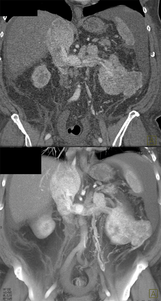 RCC Invades Renal Vein, IVC and Right Atrium