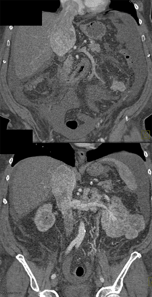 RCC Invades Renal Vein, IVC and Right Atrium