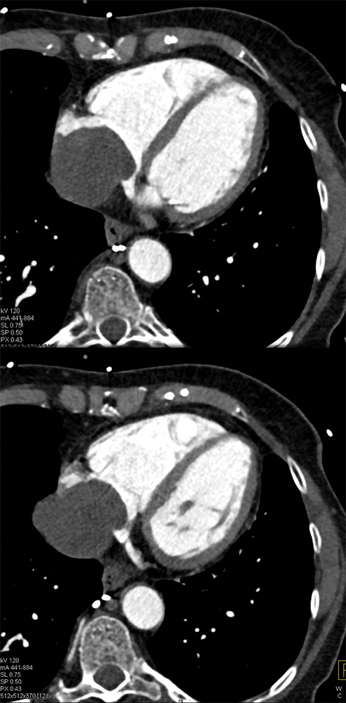 Sarcoma Invades IVC and Right Atrium (stromal sarcoma)