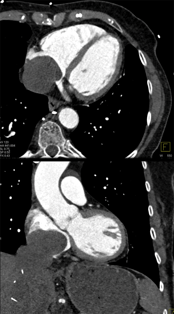 Sarcoma Invades IVC and Right Atrium (stromal sarcoma)