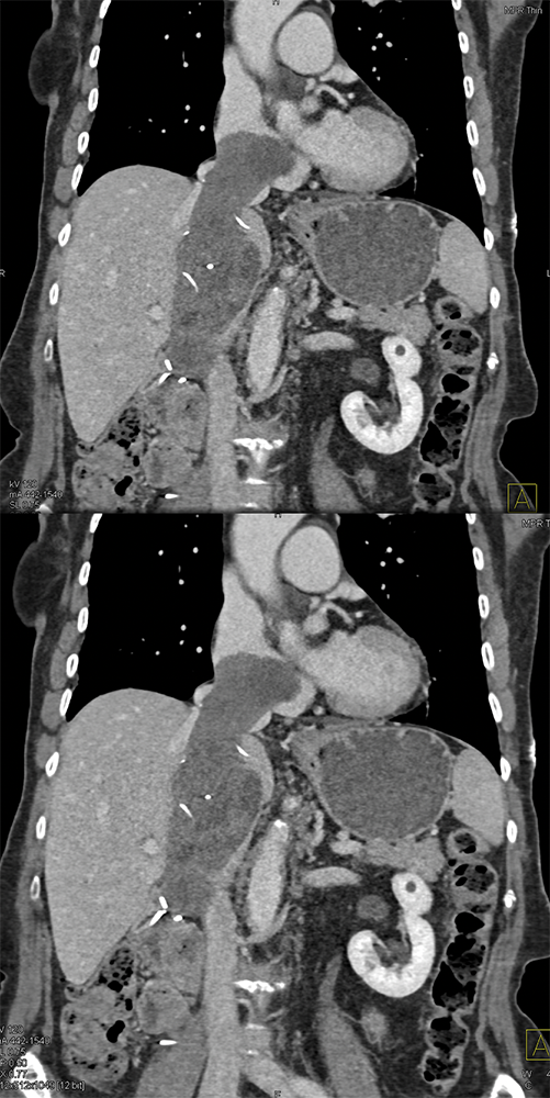 Sarcoma Invades IVC and Right Atrium (stromal sarcoma)