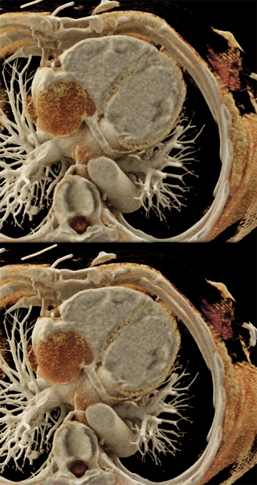 Sarcoma Invades IVC and Right Atrium (stromal sarcoma)