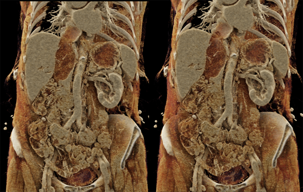 Sarcoma Invades IVC and Right Atrium (stromal sarcoma)