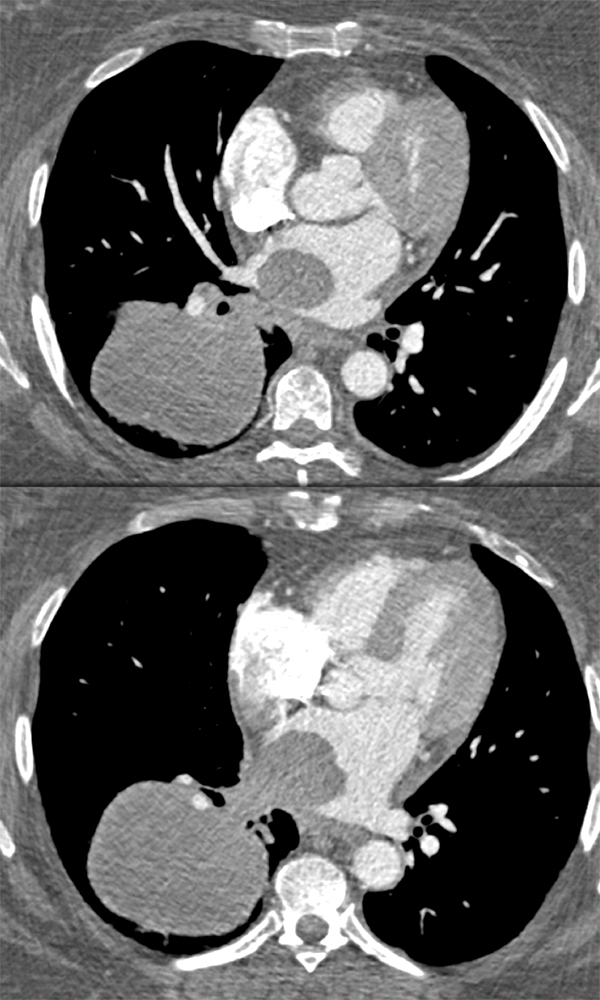 Metastatic Melanoma Grows into Left Atrium