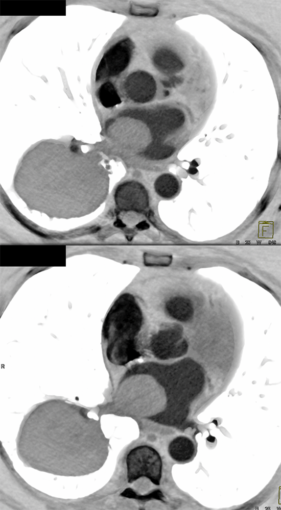 Metastatic Melanoma Grows into Left Atrium