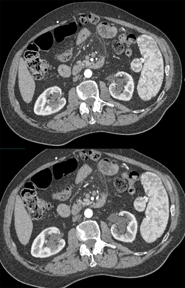 Accessory Spleen with Arterial and Venous Phase Imaging