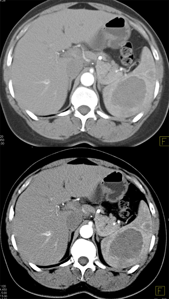 Littoral Cell Angioma