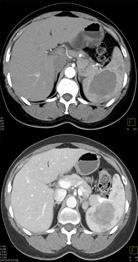 MDCT of the Spleen