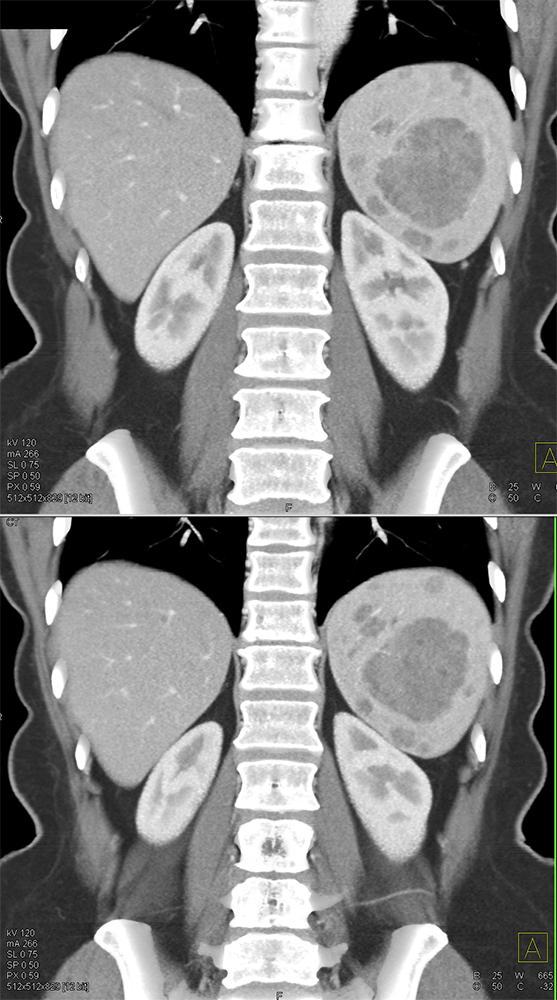 MDCT of the Spleen