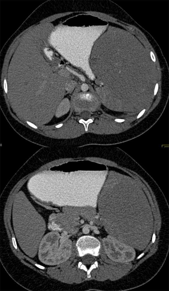 Inflammatory Pseudotumor of the Spleen