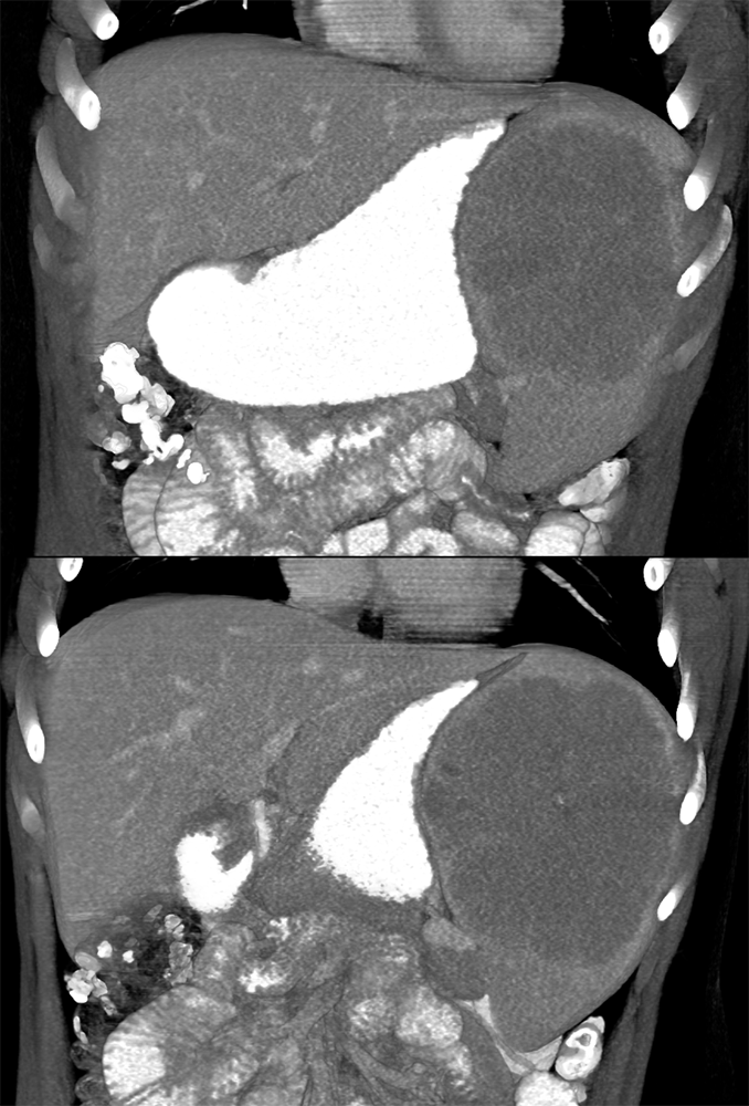 MDCT of the Spleen