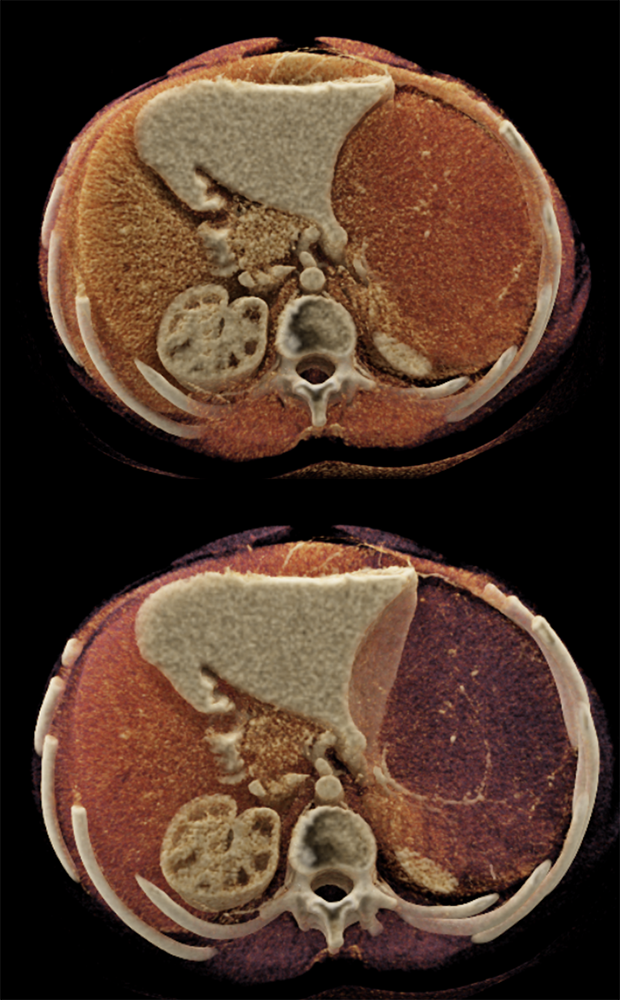 MDCT of the Spleen