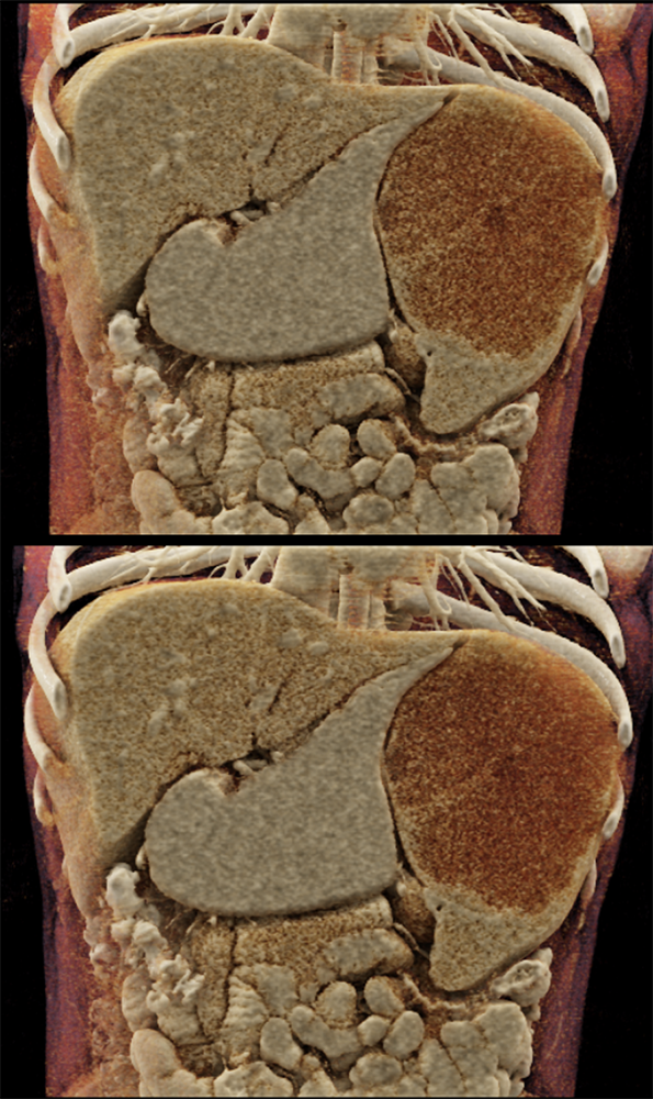 MDCT of the Spleen