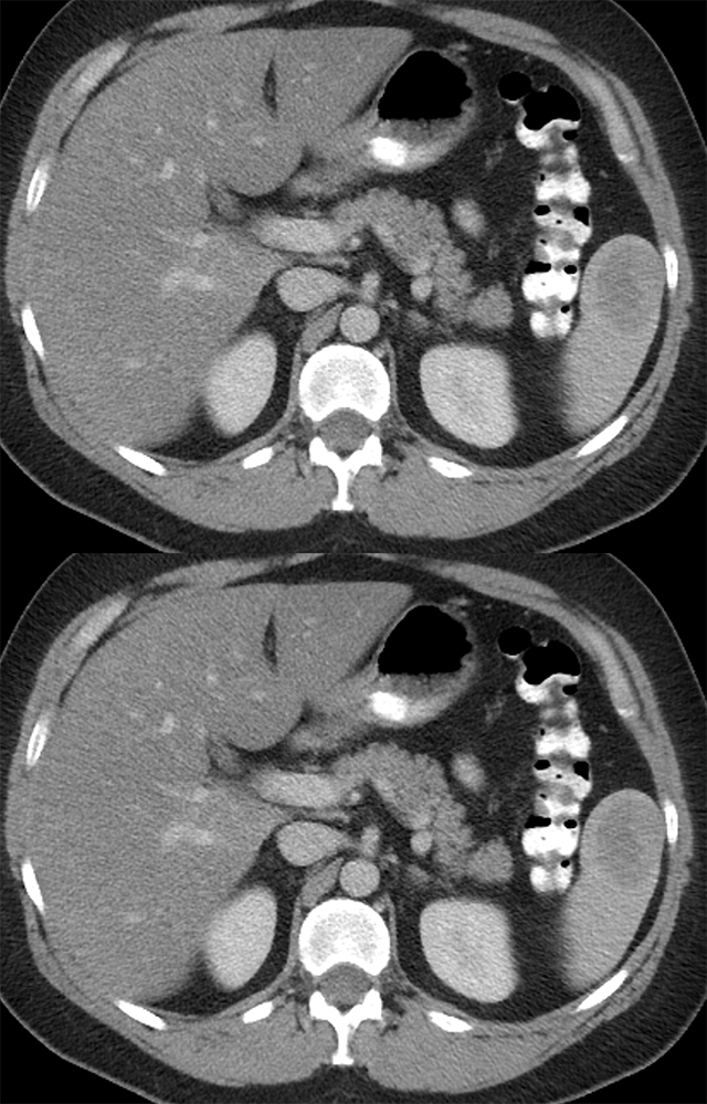 MDCT of the Spleen