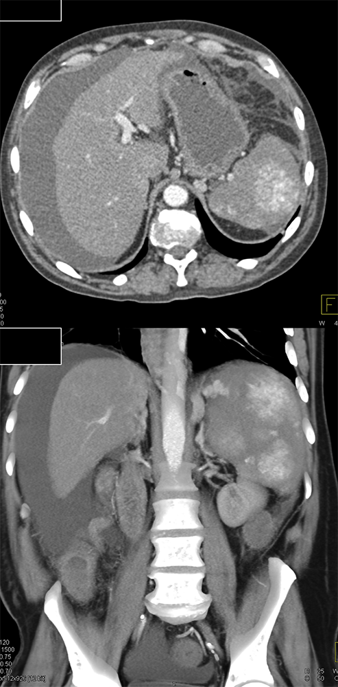 Angiosarcoma Spleen and Liver