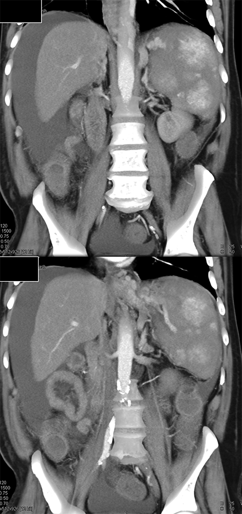 MDCT of the Spleen