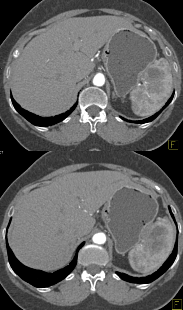 Metastatic Ovarian cancer to Spleen