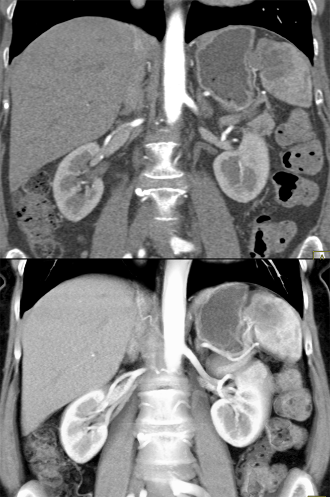 MDCT of the Spleen