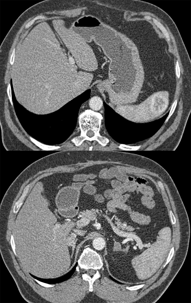 Splenic and Adrenal Metastases from RCC