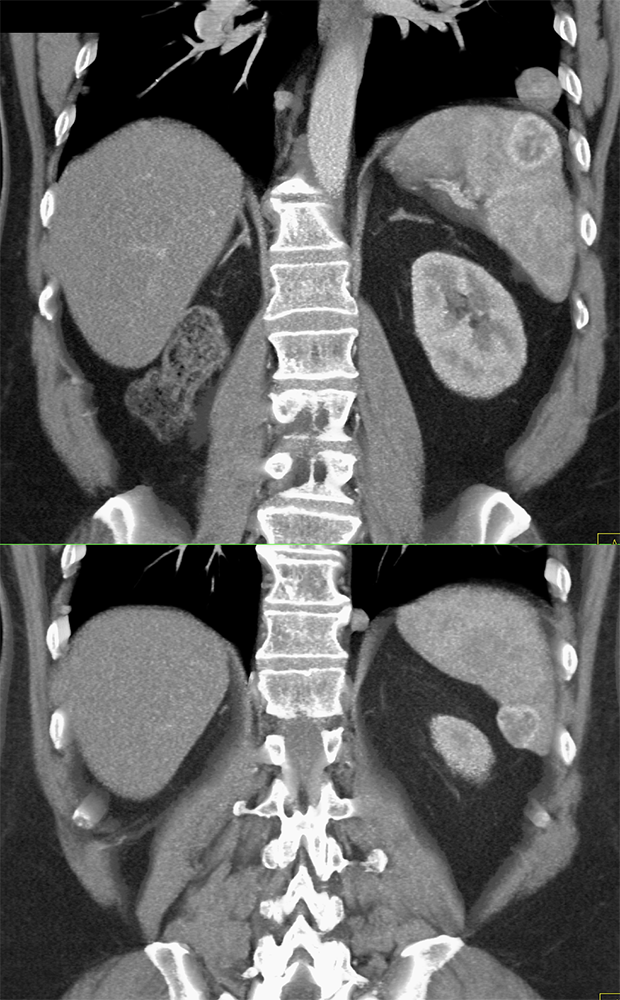 MDCT of the Spleen