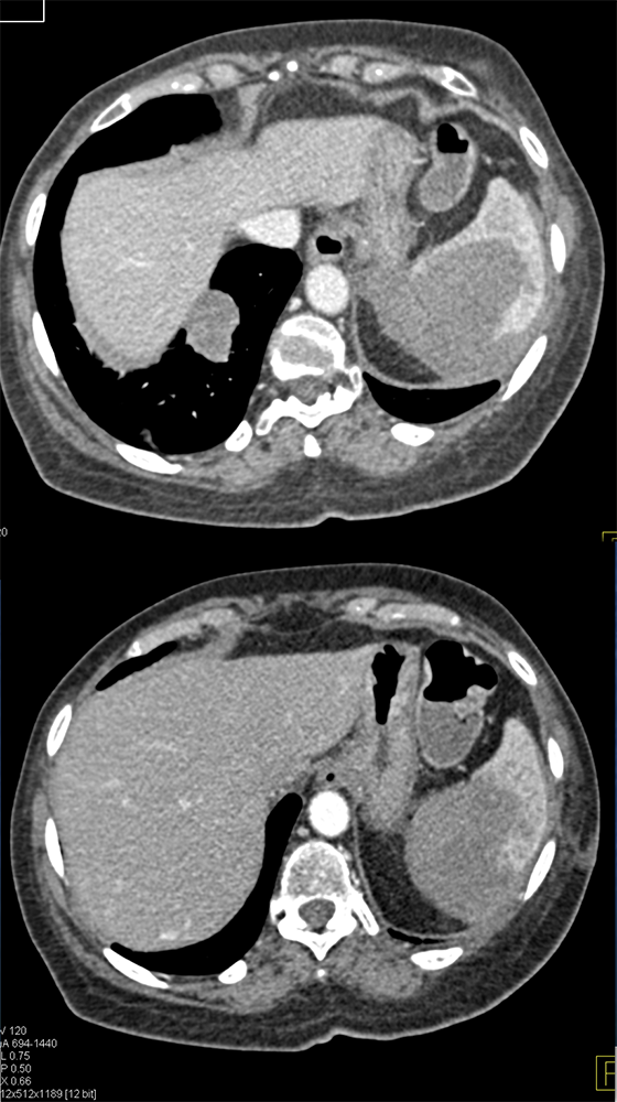 Metastatic Neuroendocrine Lung to Spleen