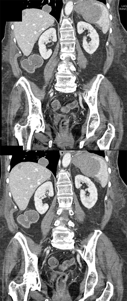 MDCT of the Spleen