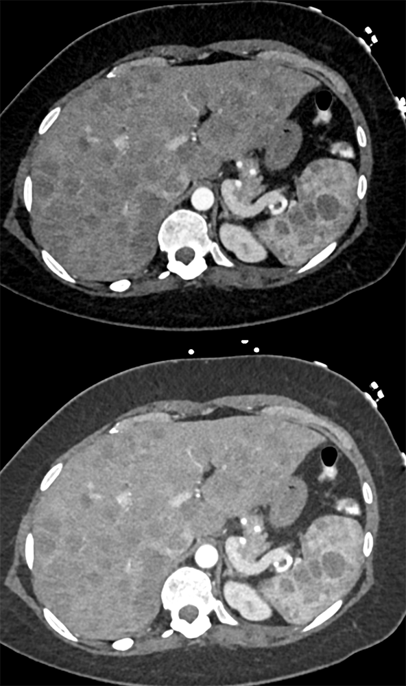 Melanoma Metastatic to the Liver and Spleen