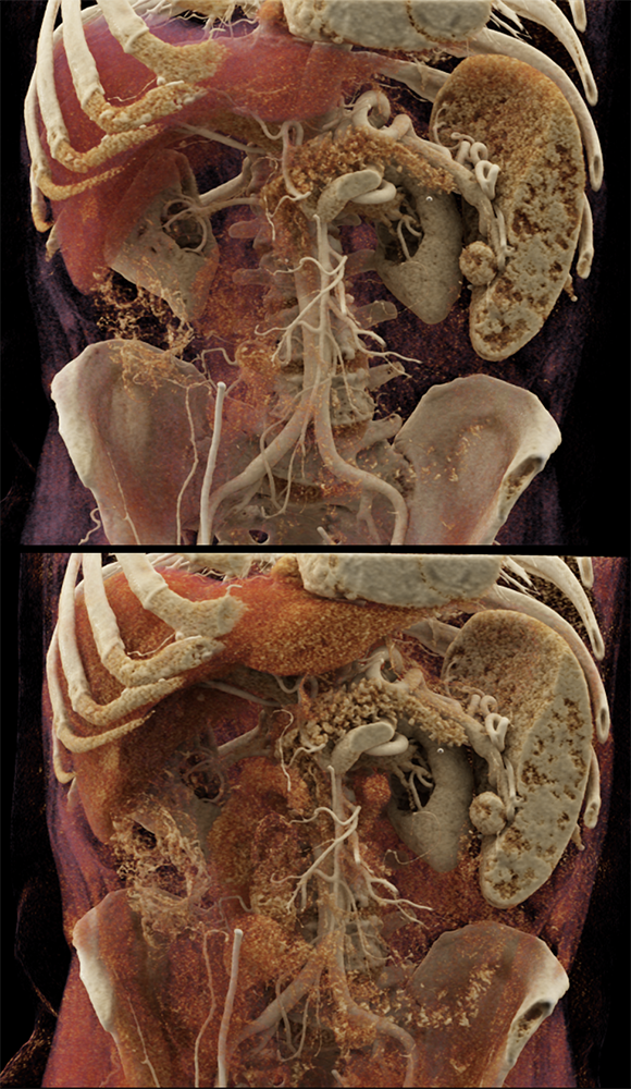 CT of the Spleen