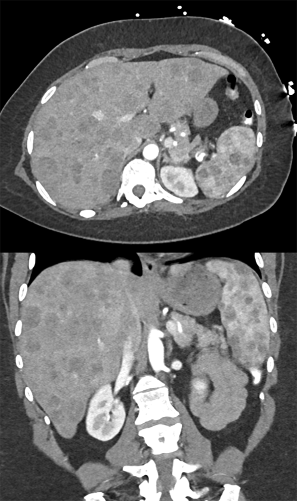 MDCT of the Spleen