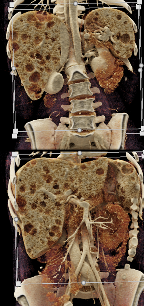 MDCT of the Spleen