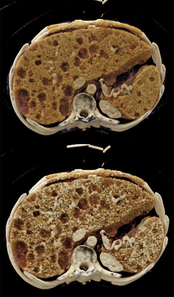 MDCT of the Spleen