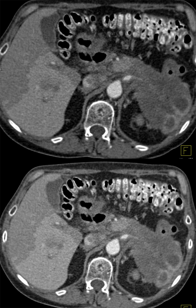 Pancreatic Cancer Invades the Spleen