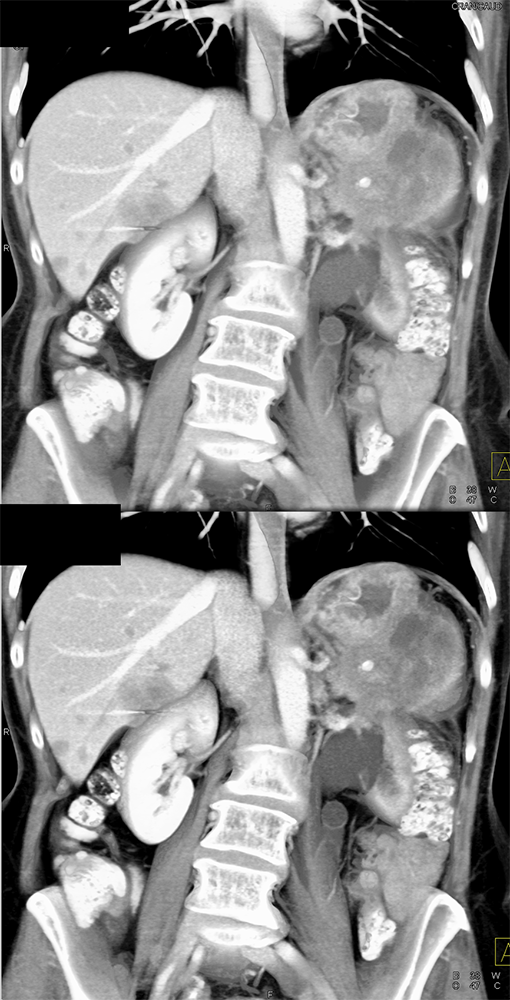 MDCT of the Spleen