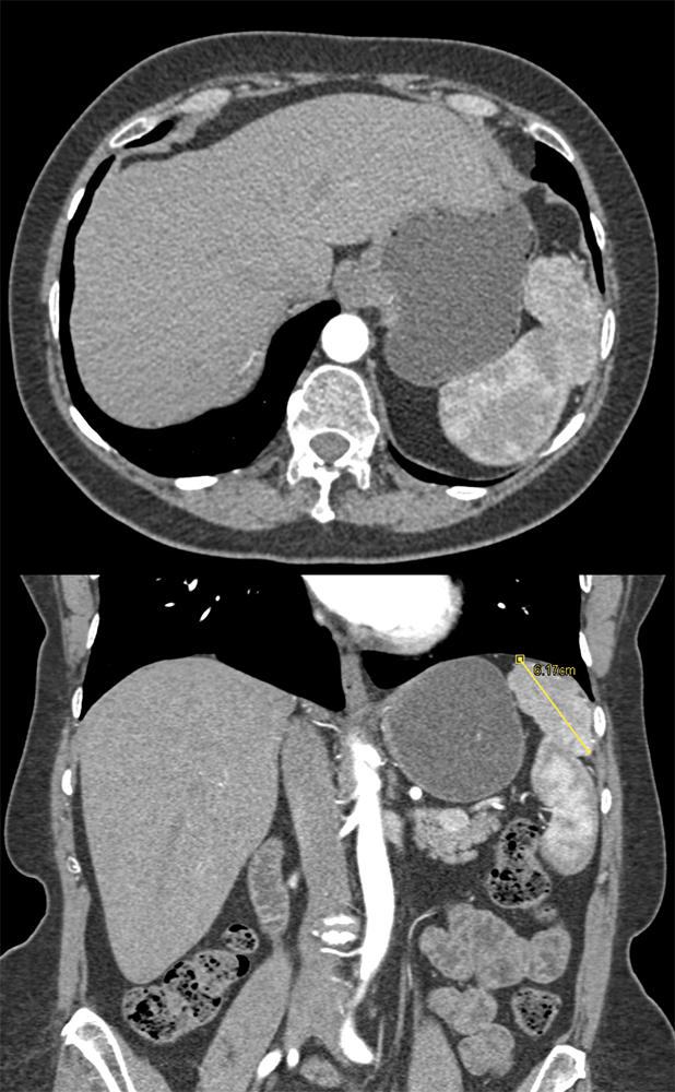 Mass Above Spleen is Accessory Spleen