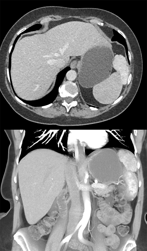 MDCT of the Spleen