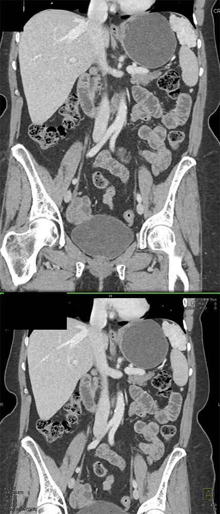 MDCT of the Spleen