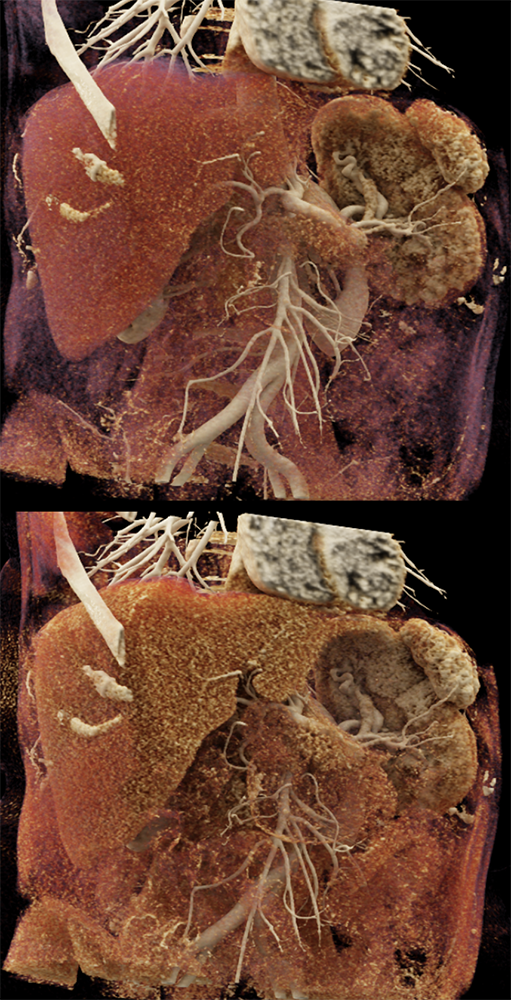 MDCT of the Spleen